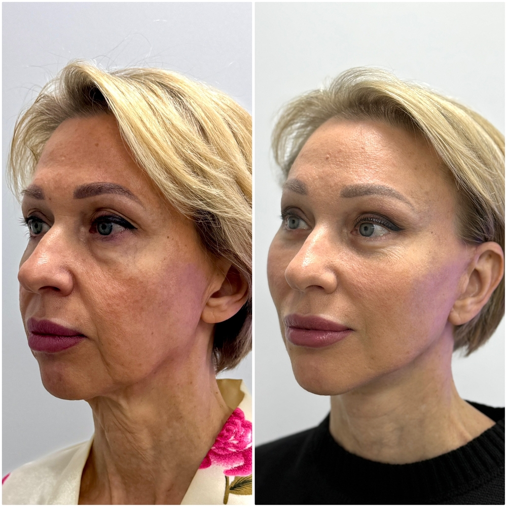 эндоскопическая подтяжка лица фото до после